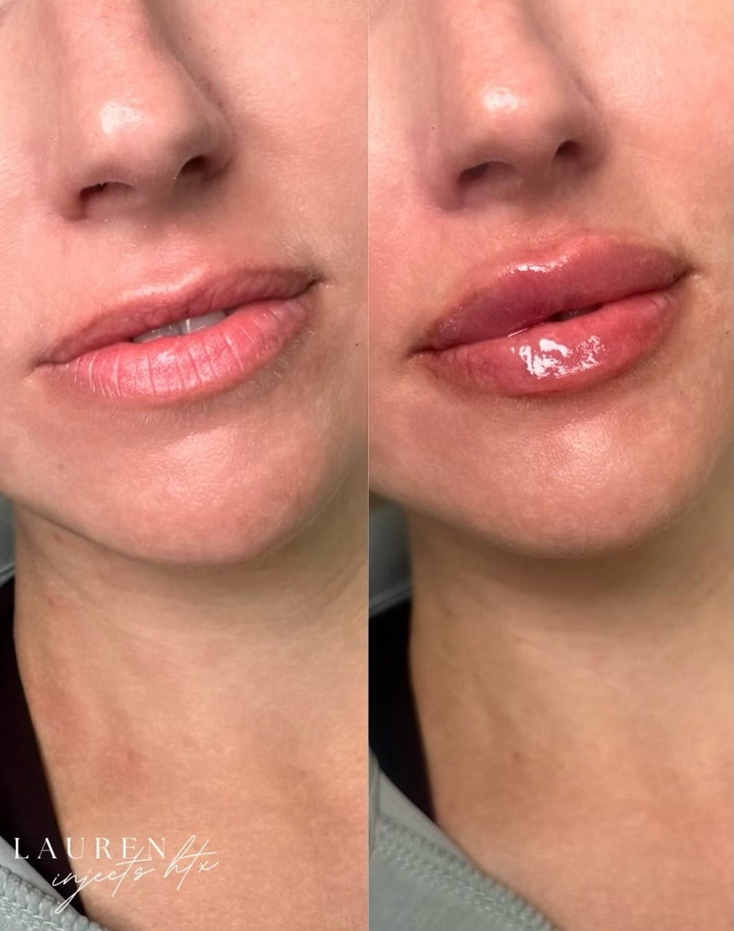 Post 2 by Lauren Moore, BSN, RN • Houston Nurse Injector on Instagram (carousel)