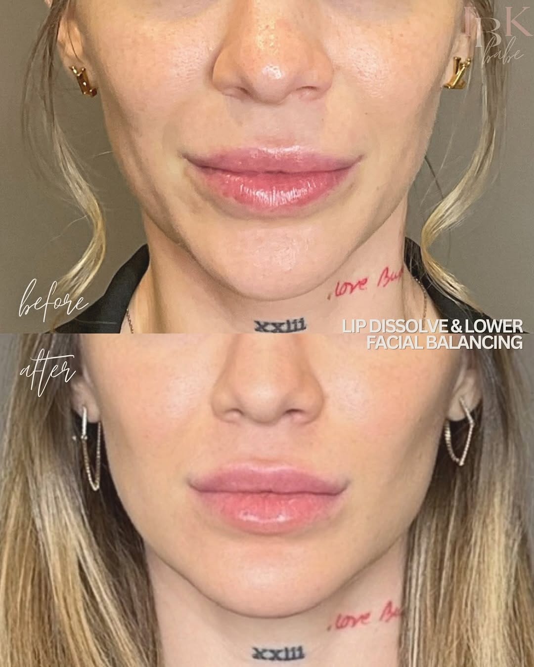 Post 9 by Houston Nurse Injector | Kristine Deal on Instagram (carousel)