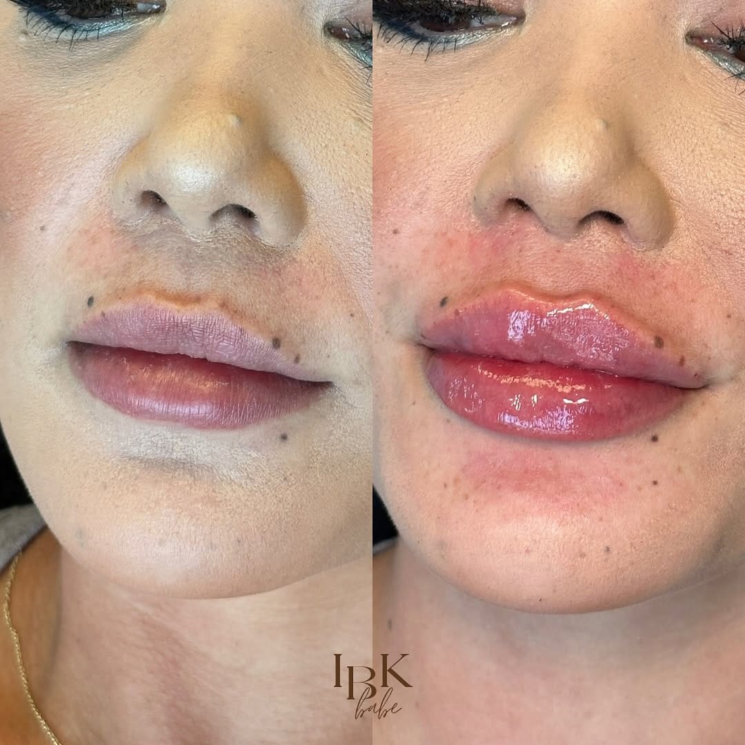 Post 10 by Houston Nurse Injector | Kristine Deal on Instagram (image)