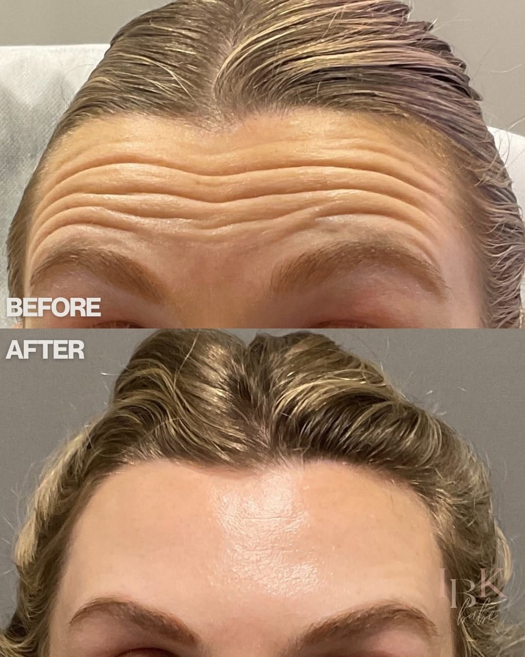 Post 1 by Houston Nurse Injector | Kristine Deal on Instagram (carousel)
