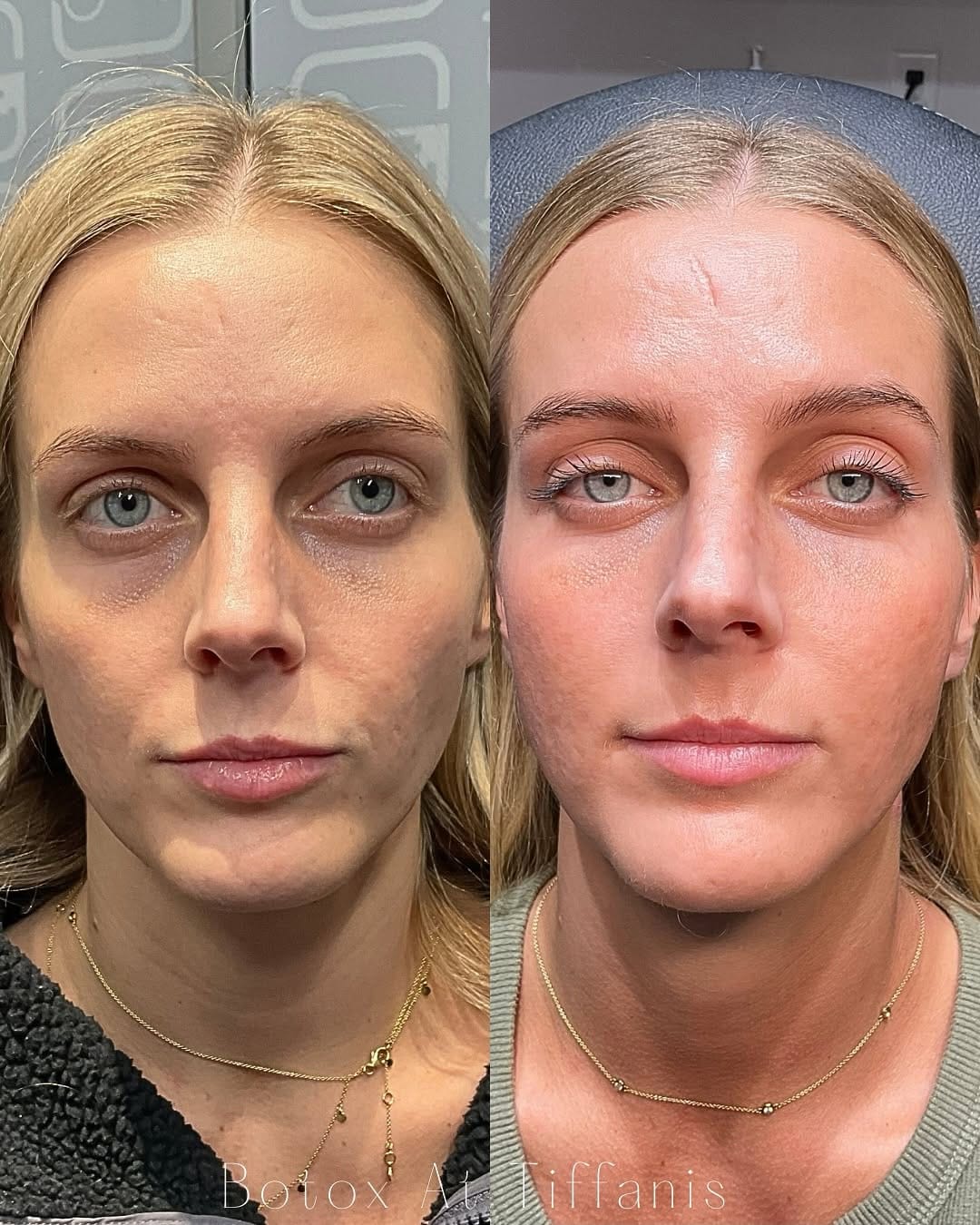 Post 5 by Tiffani Terrell, RN Injector  💋 on Instagram (carousel)