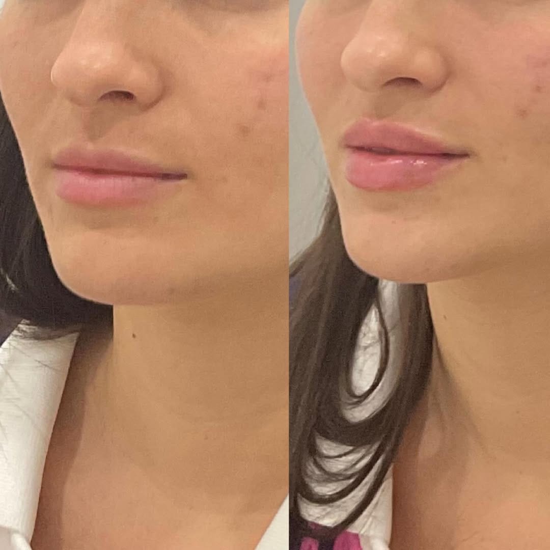 Post 4 by Fillers, Botox, Lip Filler on Instagram (image)