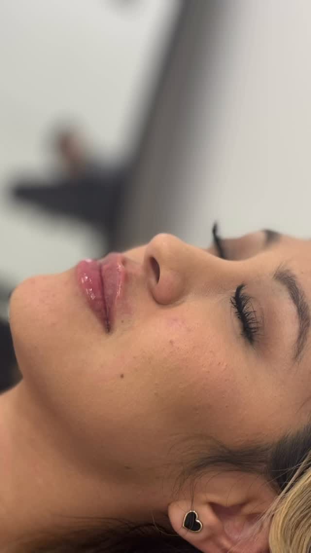 Post 6 by Fillers, Botox, Lip Filler on Instagram (video)