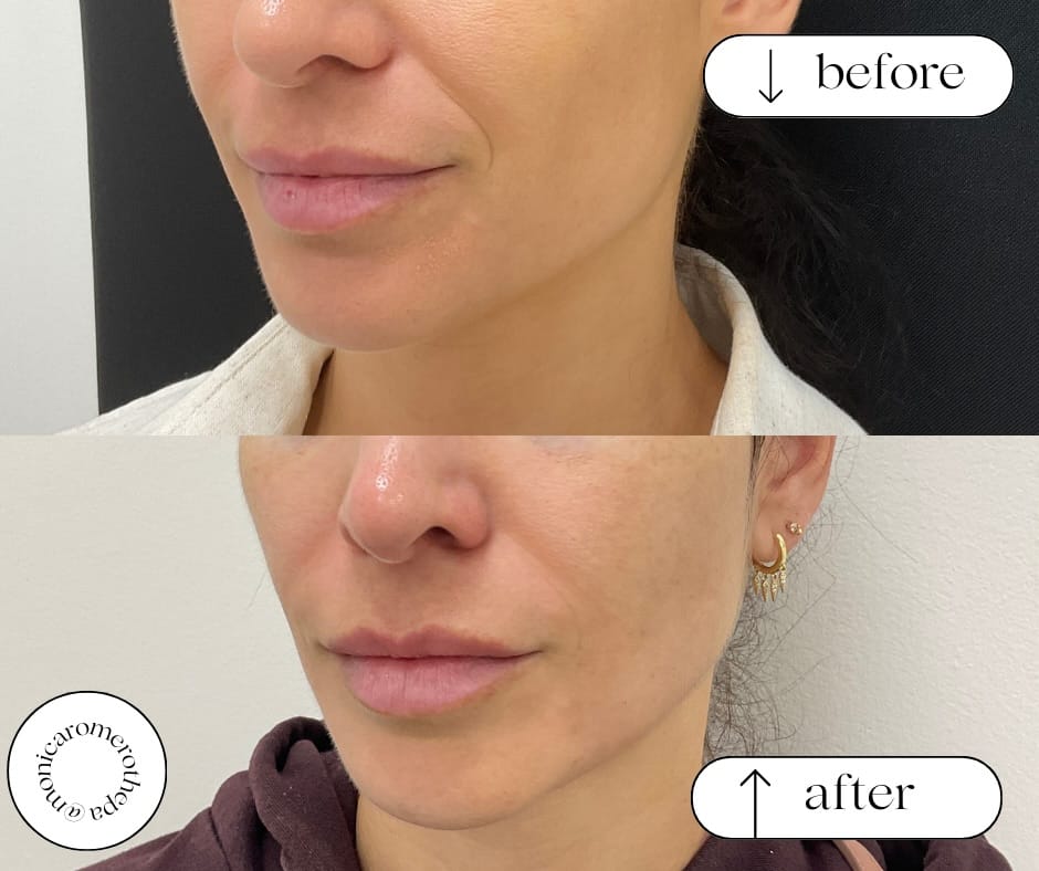 Post 6 by Monica Romero | Miami Botox + Fillers + Lasers + Skincare on Instagram (image)