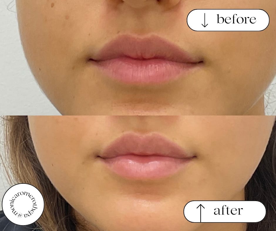 Post 7 by Monica Romero | Miami Botox + Fillers + Lasers + Skincare on Instagram (image)