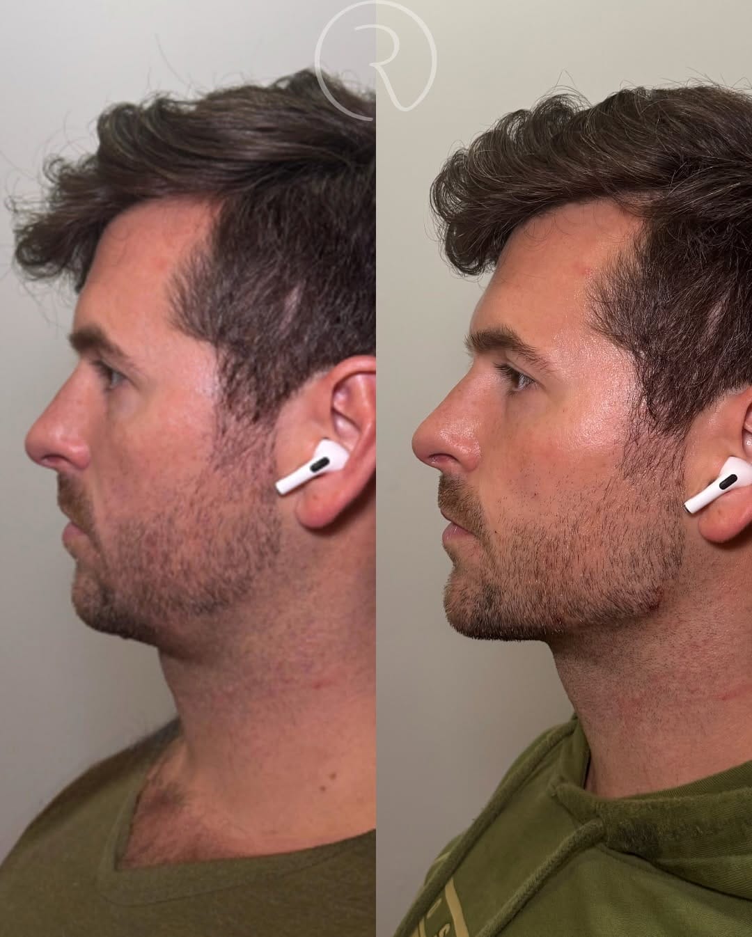 Post 4 by Dr. Elizabeth | AESTHETIC INJECTOR on Instagram (carousel)