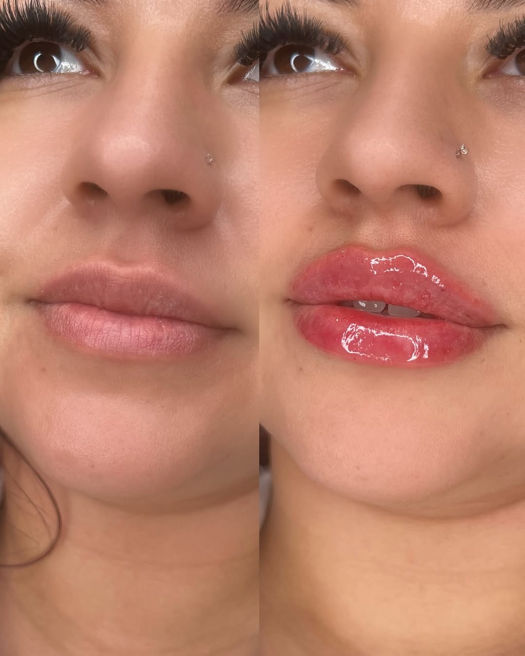Post 6 by Vanessa Mondragon BSN, RN | Dallas Injector on Instagram (image)