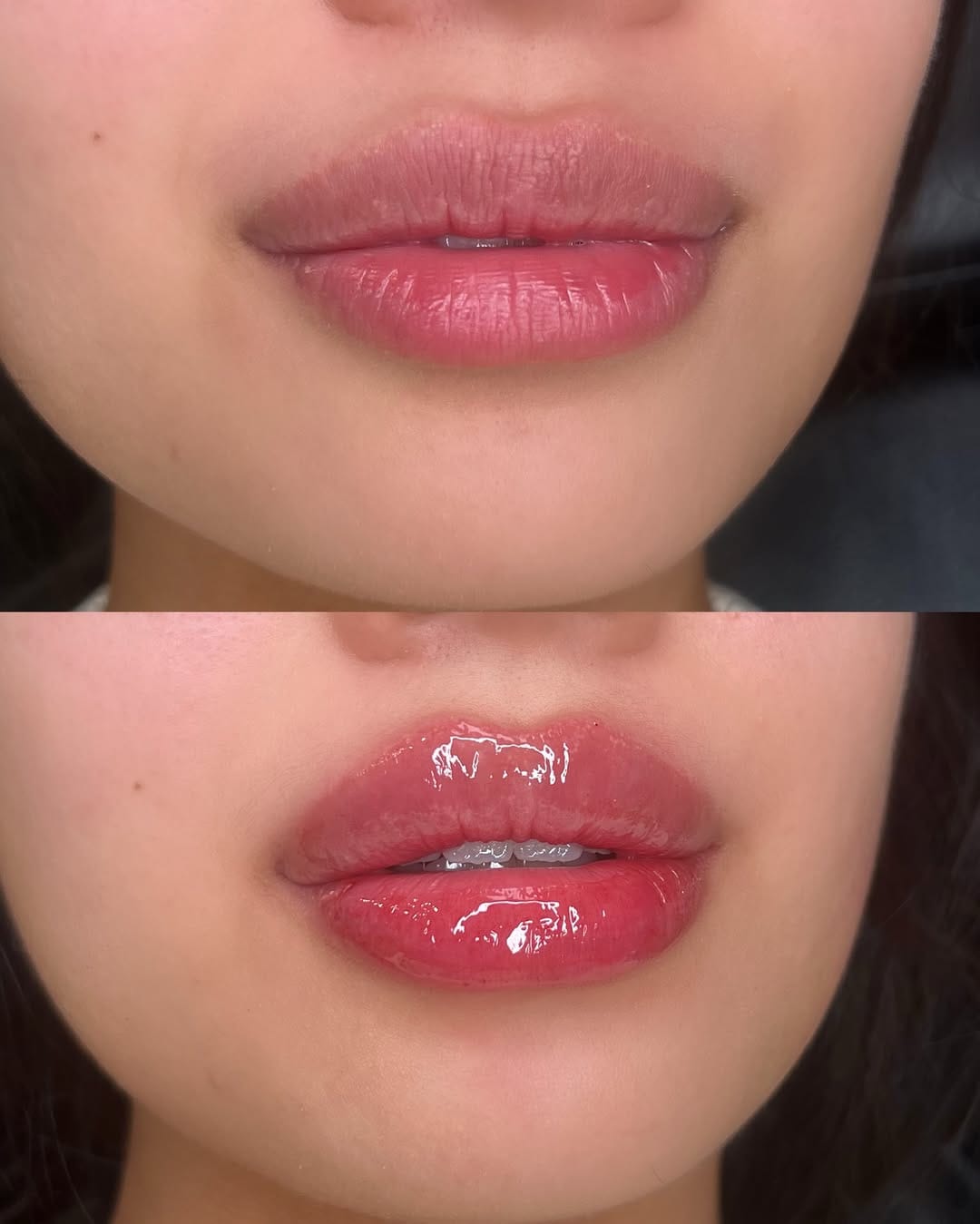 Post 5 by Vanessa Mondragon BSN, RN | Dallas Injector on Instagram (image)