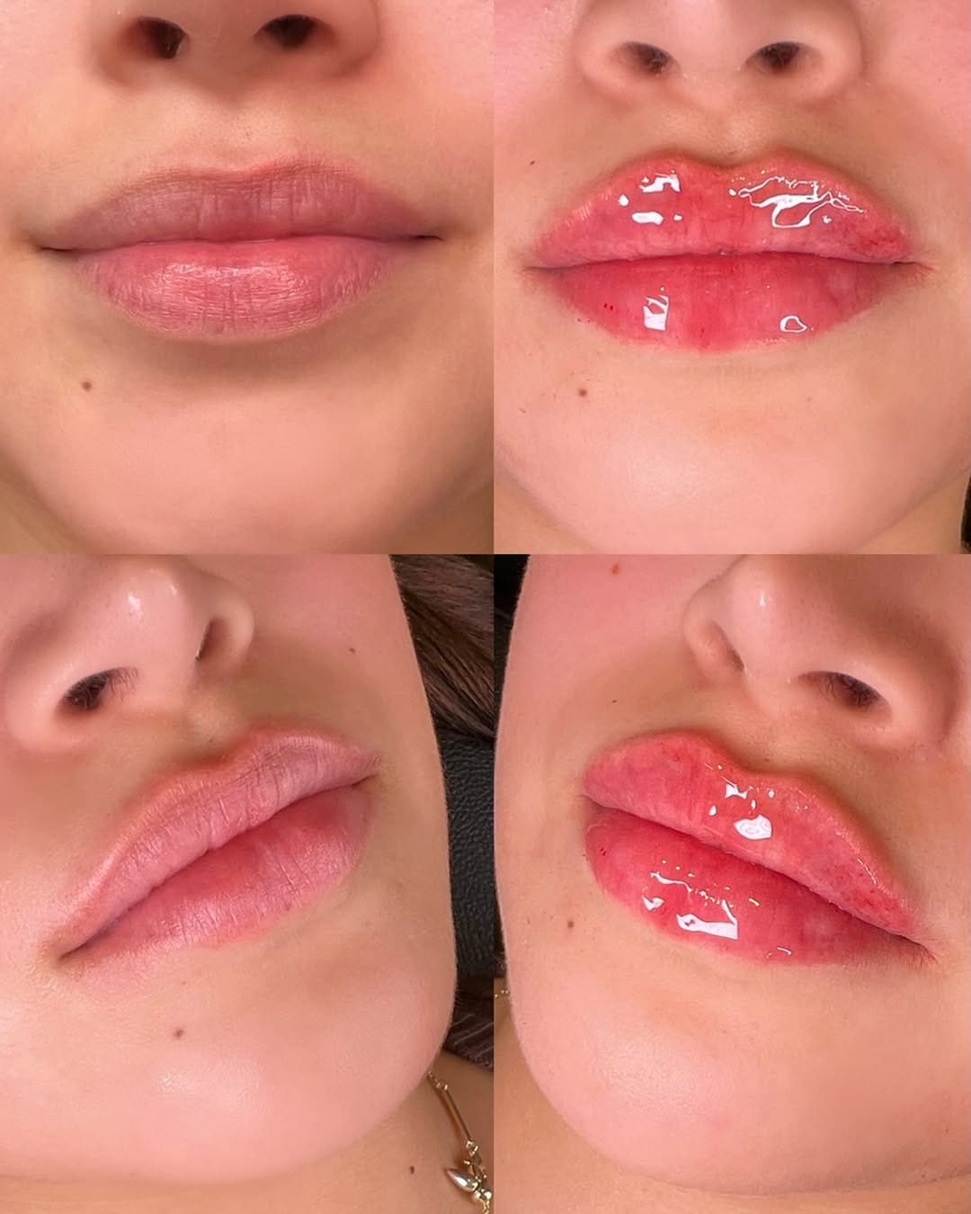 Post 2 by Vanessa Mondragon BSN, RN | Dallas Injector on Instagram (image)