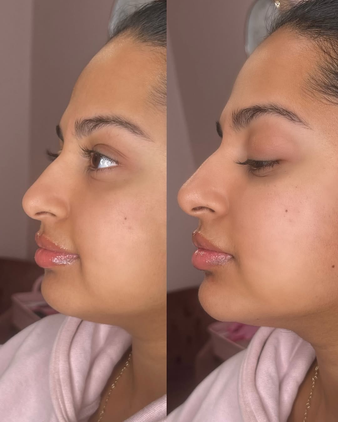 Post 7 by Vanessa Mondragon BSN, RN | Dallas Injector on Instagram (carousel)