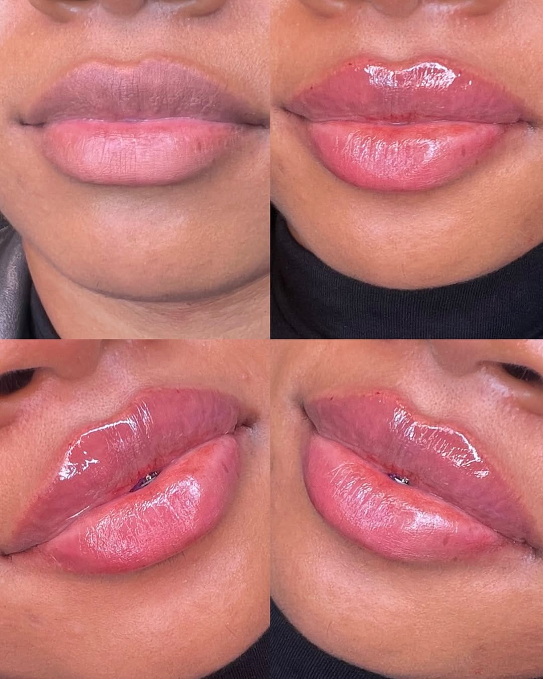 Post 4 by Vanessa Mondragon BSN, RN | Dallas Injector on Instagram (carousel)