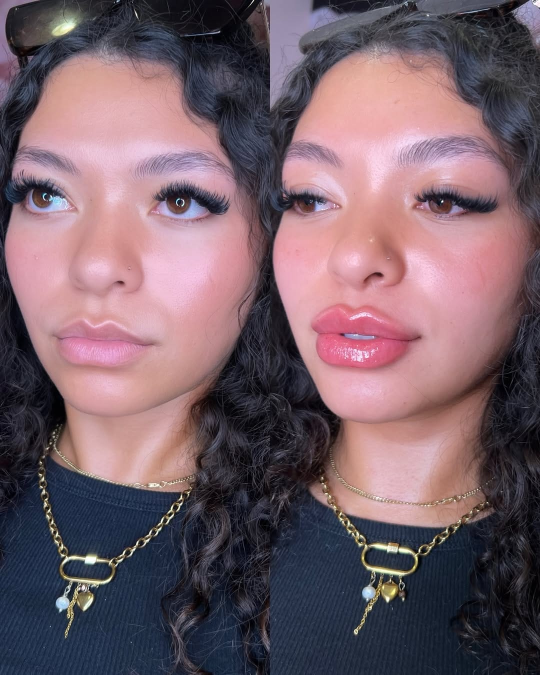 Post 8 by Vanessa Mondragon BSN, RN | Dallas Injector on Instagram (image)