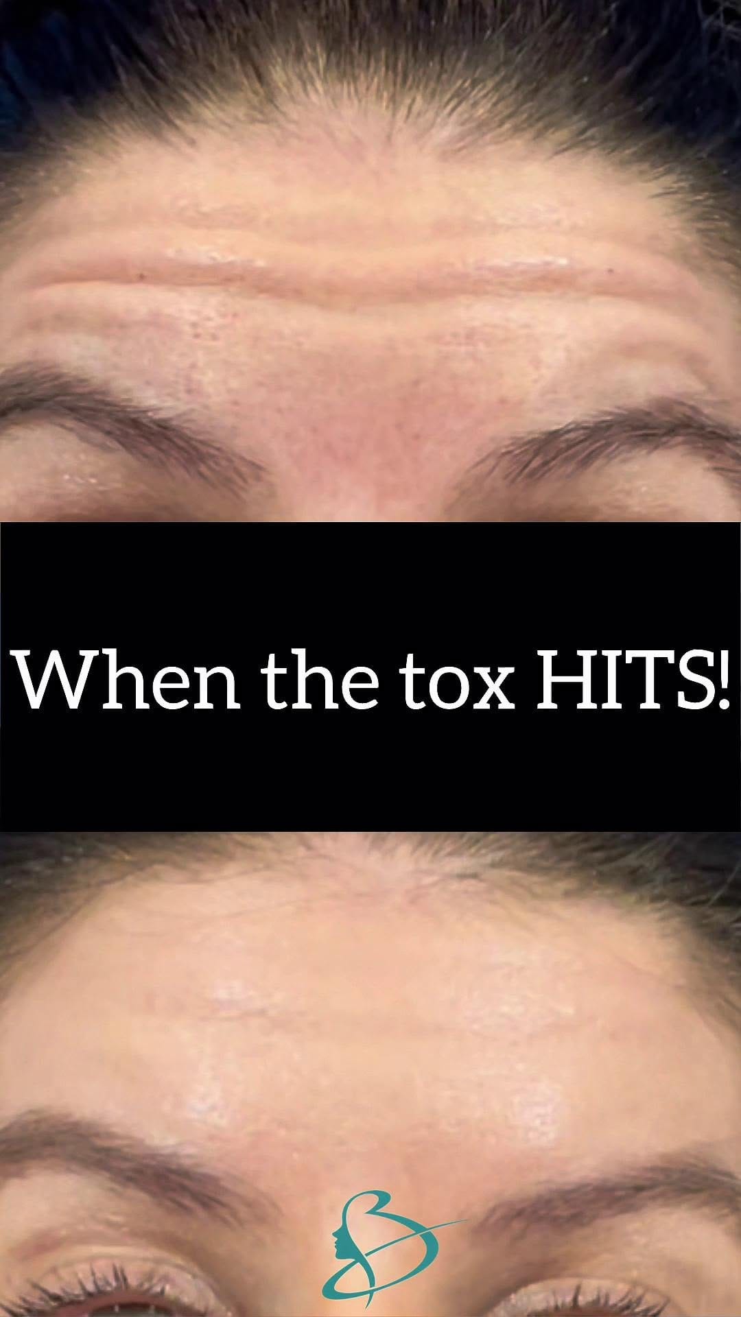 Post 6 by Mark Beaty, MD | Facelift | Rhinoplasty | Botox | Filler | Laser on Instagram (video)