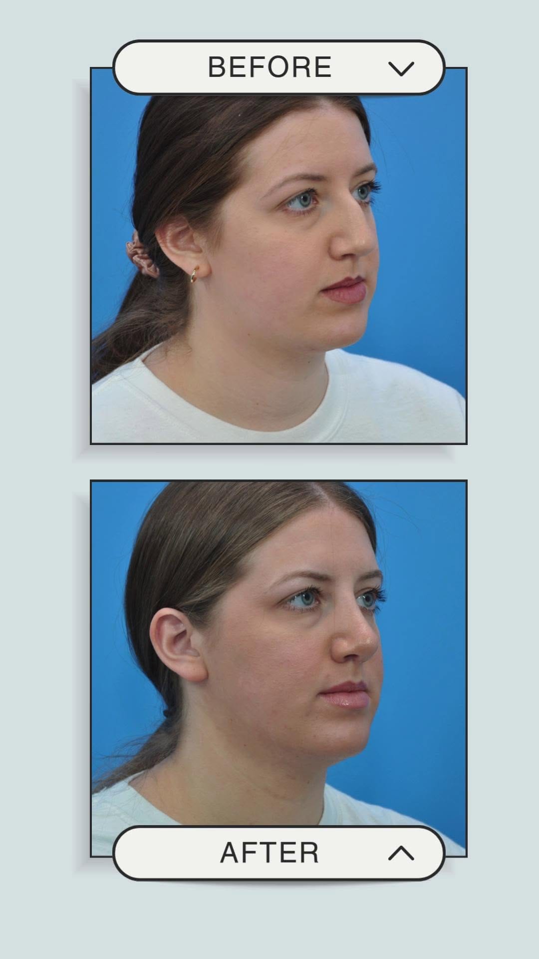 Post 2 by Mark Beaty, MD | Facelift | Rhinoplasty | Botox | Filler | Laser on Instagram (video)