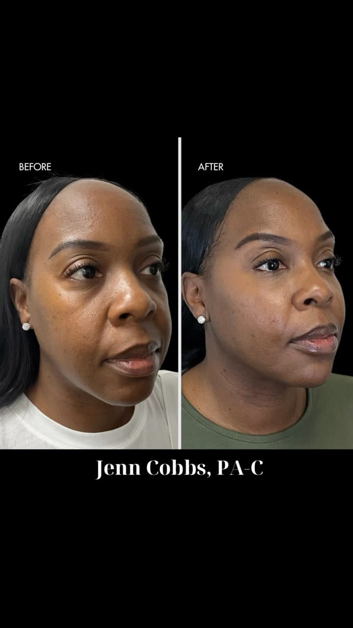 Post 10 by Jenn Cobbs, PA-C | ATL Injector 💉 on Instagram (video)