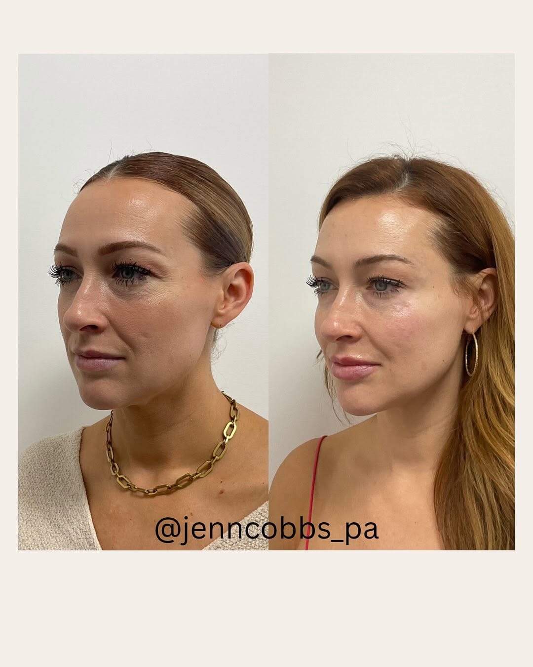 Post 8 by Jenn Cobbs, PA-C | ATL Injector 💉 on Instagram (carousel)