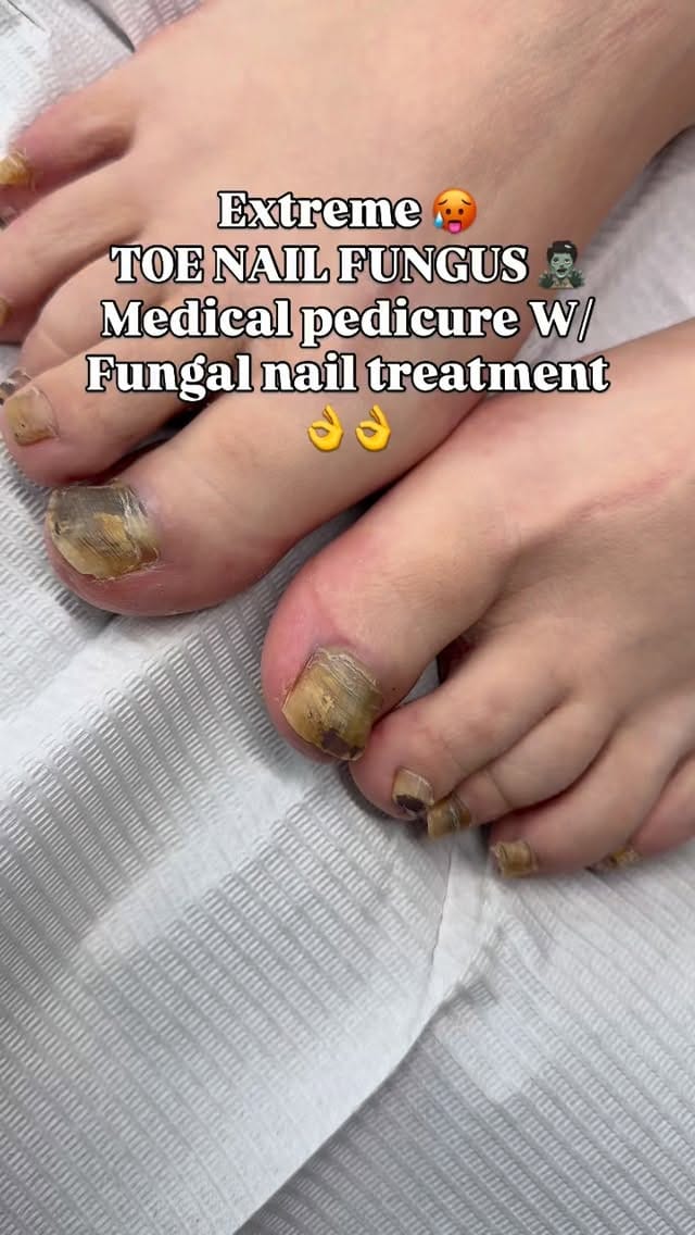 Post 1 by DTLA FUNGAL TOE SPECIALIST💅🏻 on Instagram (video)