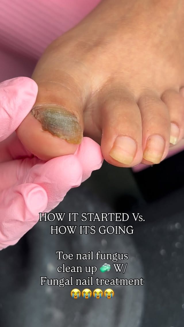Post 10 by DTLA FUNGAL TOE SPECIALIST💅🏻 on Instagram (video)