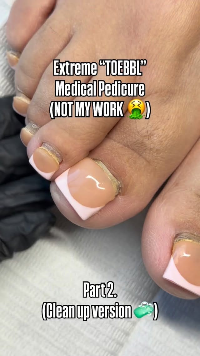 Post 7 by DTLA FUNGAL TOE SPECIALIST💅🏻 on Instagram (video)
