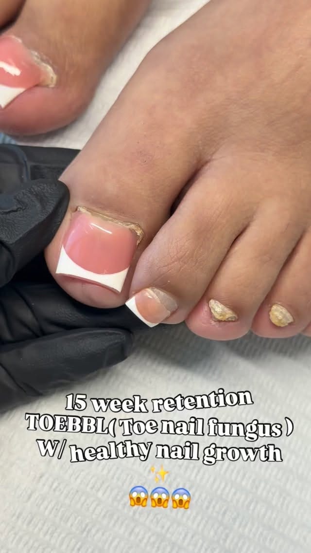 Post 5 by DTLA FUNGAL TOE SPECIALIST💅🏻 on Instagram (video)