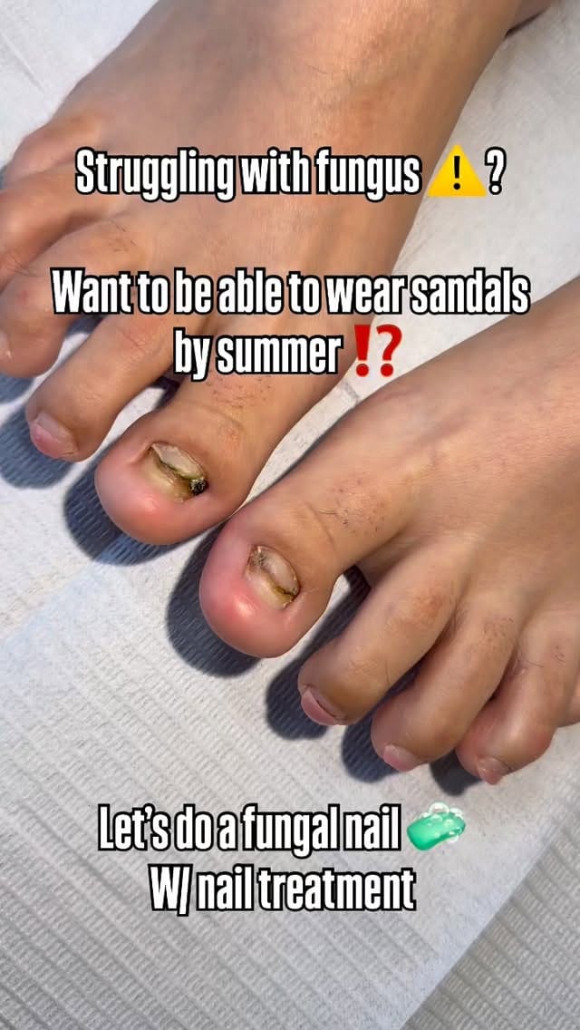 Post 9 by DTLA FUNGAL TOE SPECIALIST💅🏻 on Instagram (video)