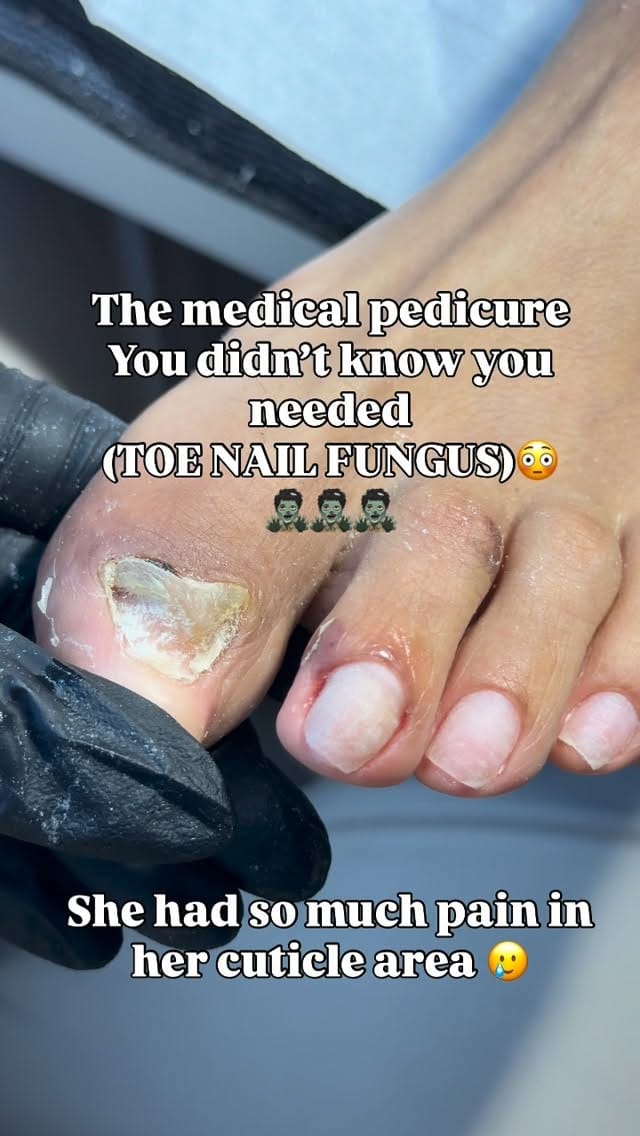 Post 2 by DTLA FUNGAL TOE SPECIALIST💅🏻 on Instagram (video)