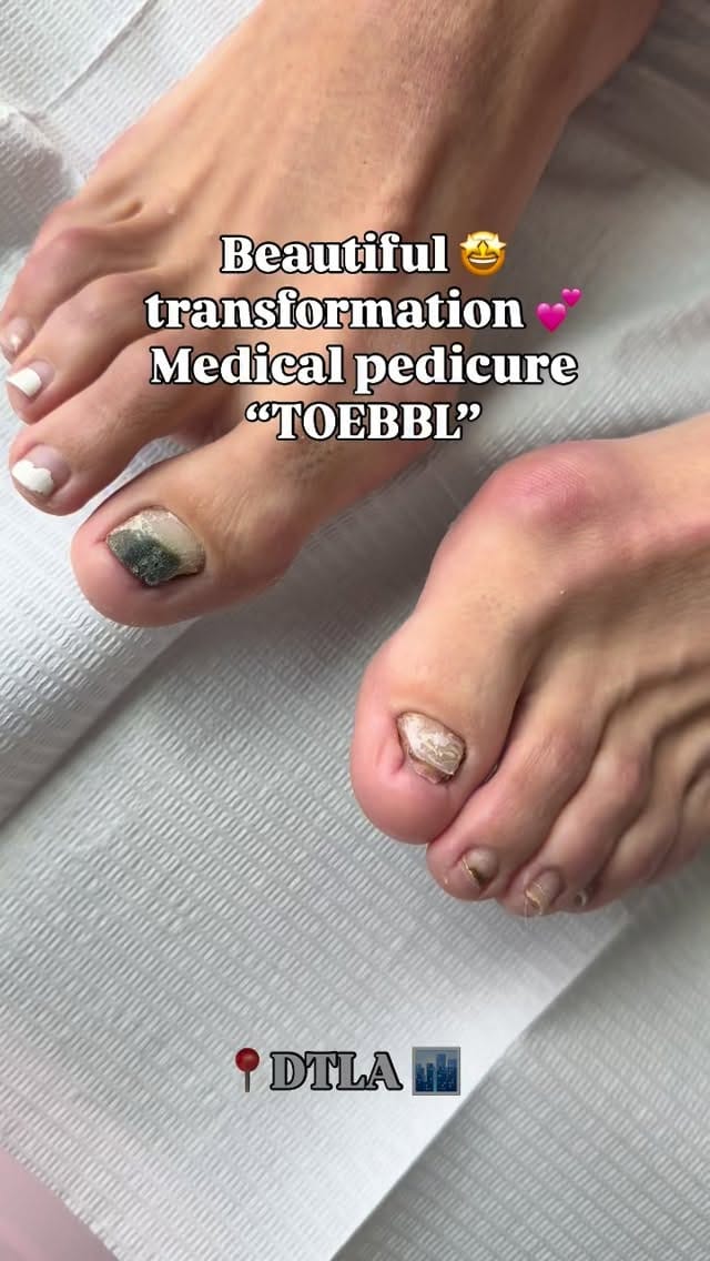 Post 4 by DTLA FUNGAL TOE SPECIALIST💅🏻 on Instagram (video)