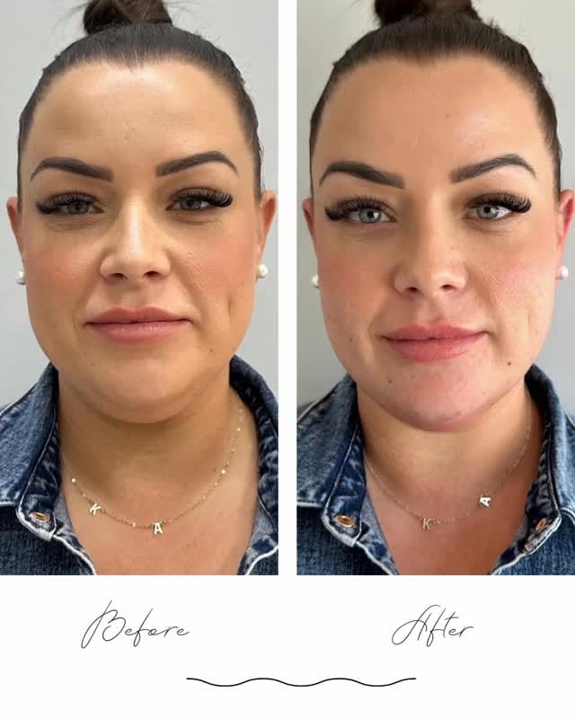 Post 7 by Dr. Carla DNP, PhD: Skin care expert, aesthetic injector on Instagram (video)