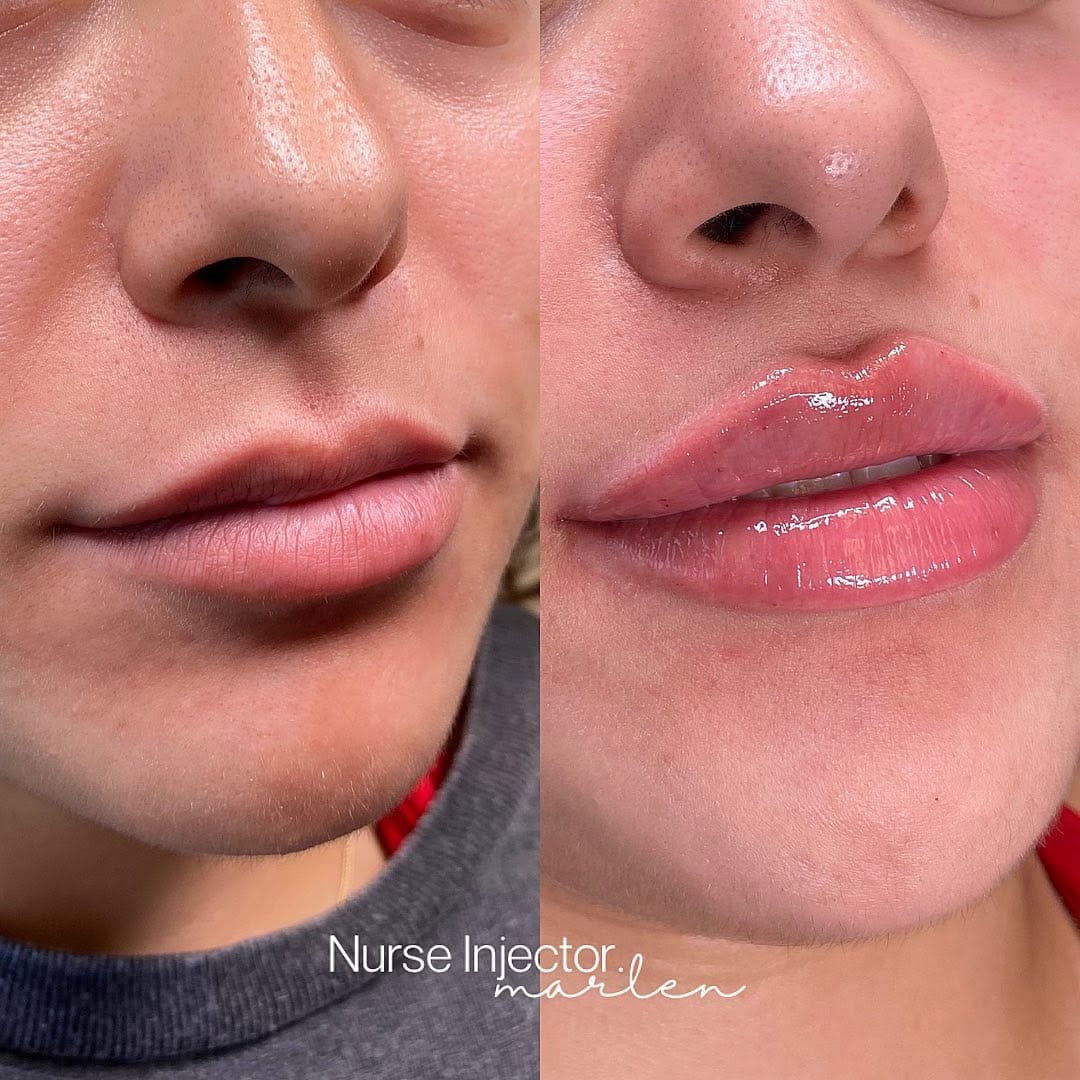 Post 9 by Marlen Gonzalez, RN | Houston Injector on Instagram (carousel)