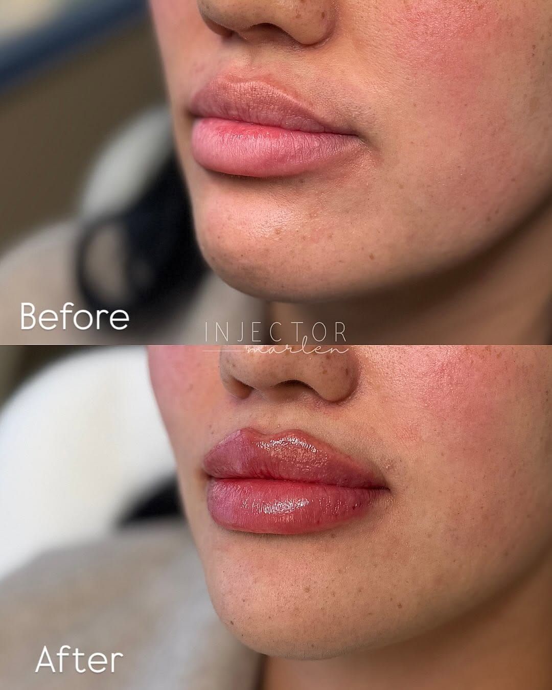 Post 8 by Marlen Gonzalez, RN | Houston Injector on Instagram (carousel)