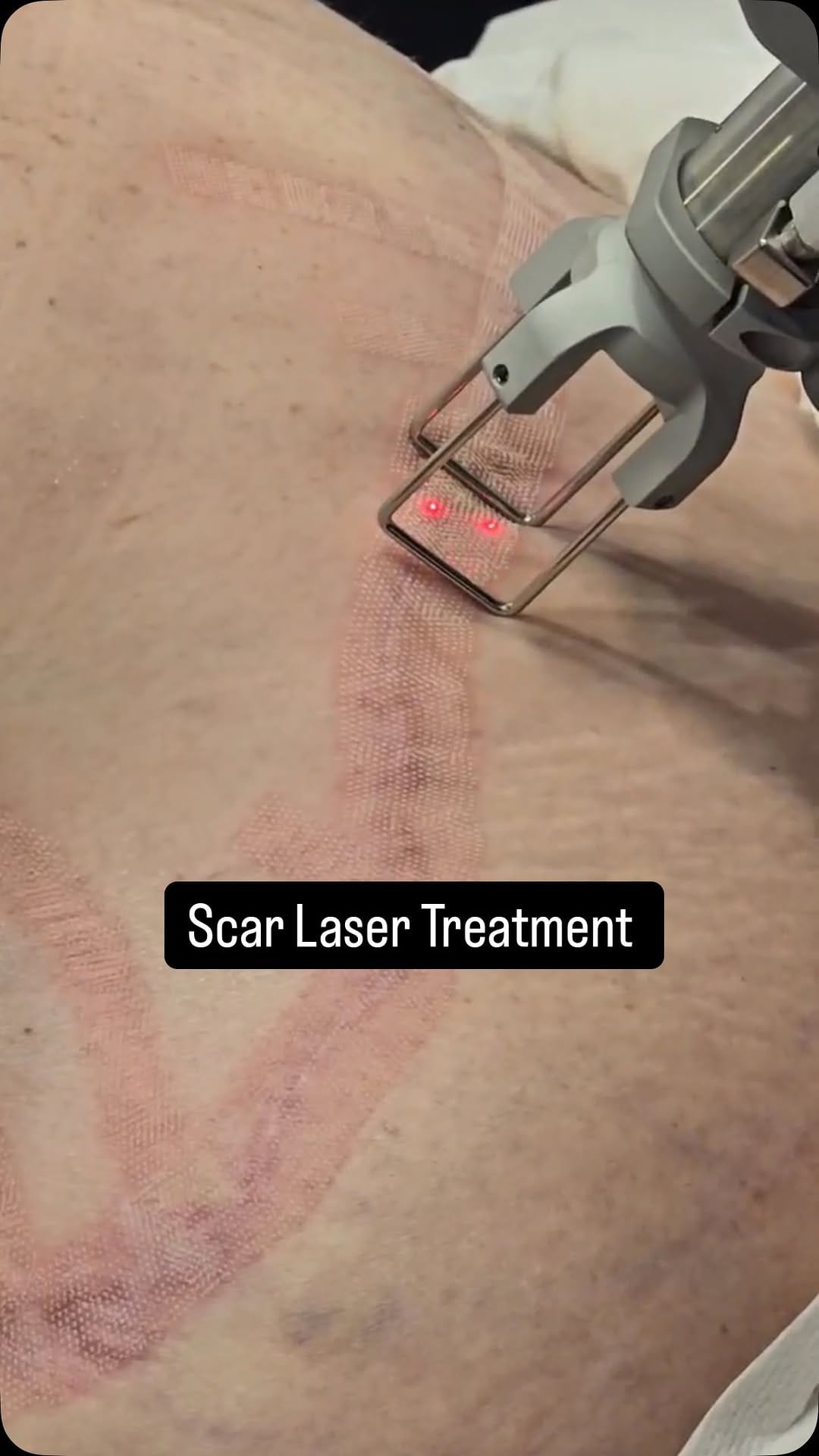 Post 7 by Stephanie B.S,PTA, MLD-C, Adv Post Operative Therapist on Instagram (video)