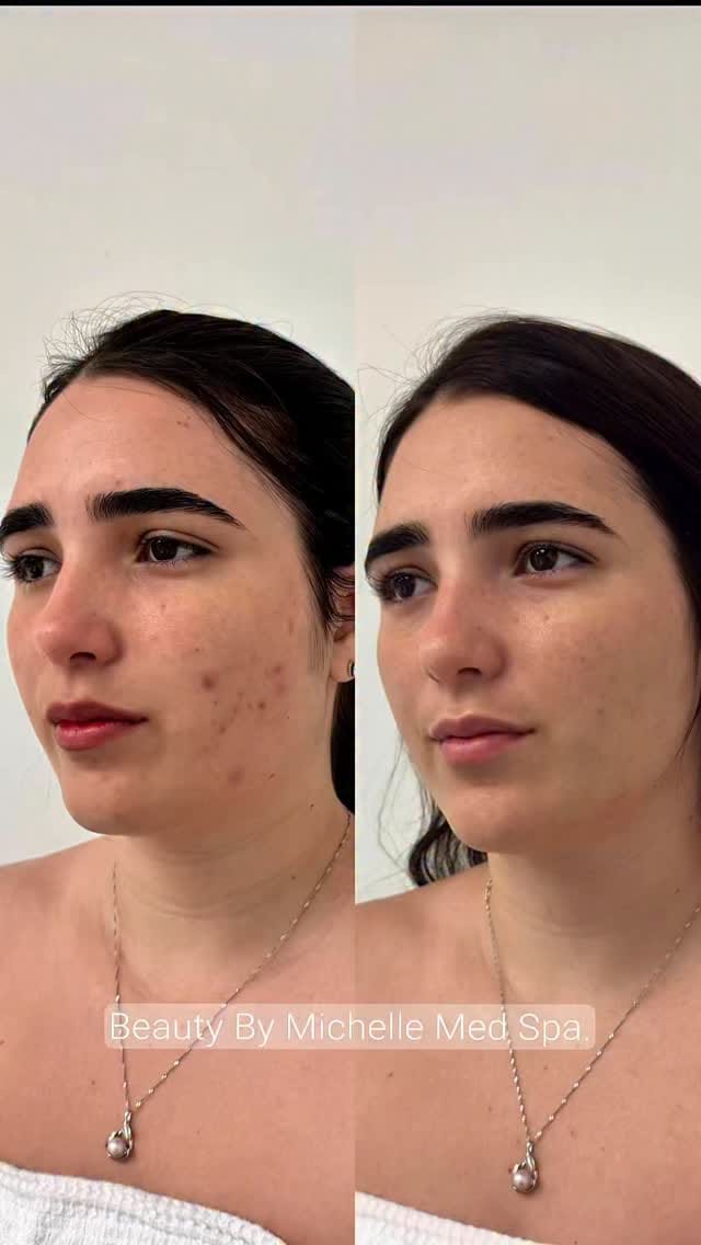 Post 1 by Beauty by Michelle Davis | Acne Specialist on Instagram (video)