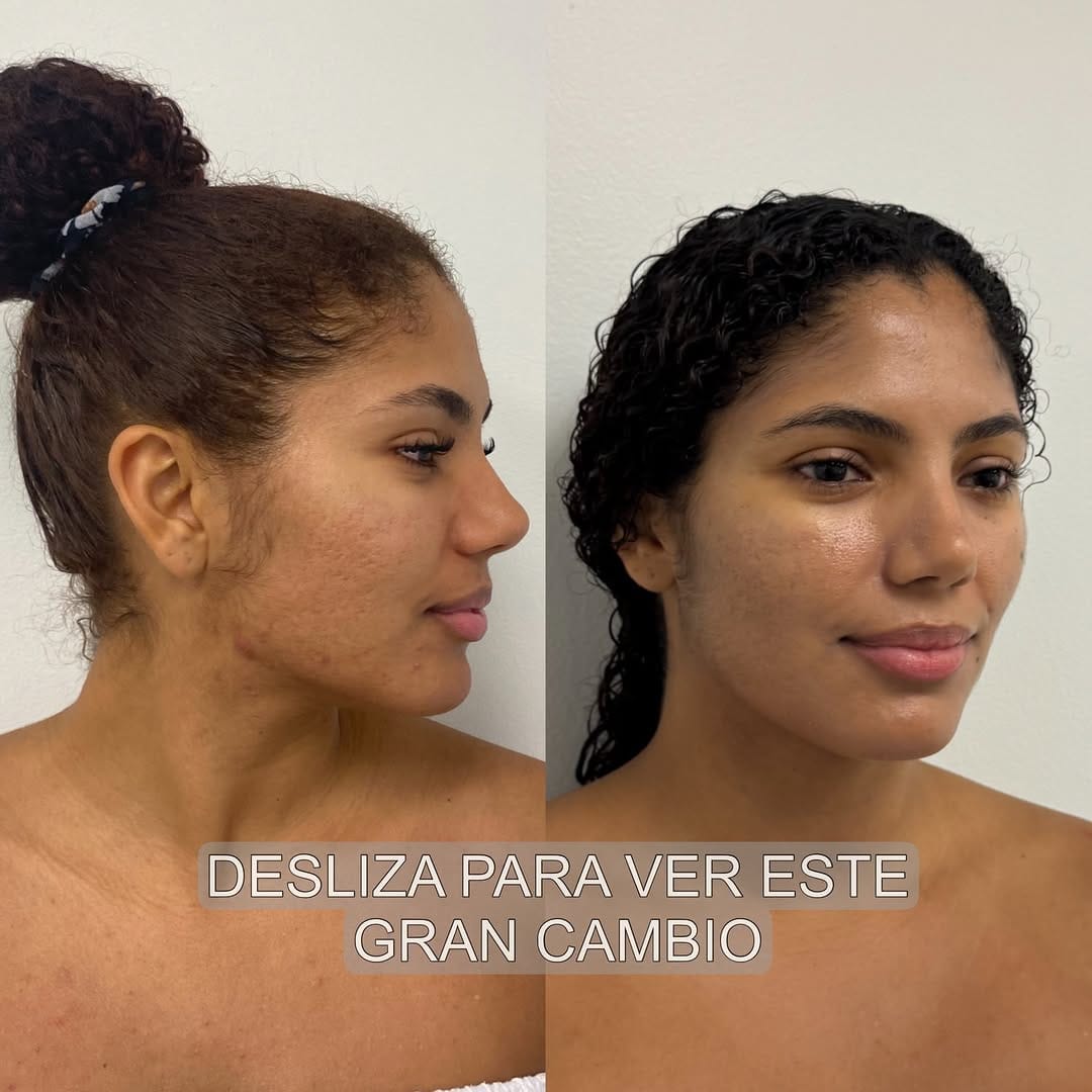 Post 7 by Beauty by Michelle Davis | Acne Specialist on Instagram (carousel)