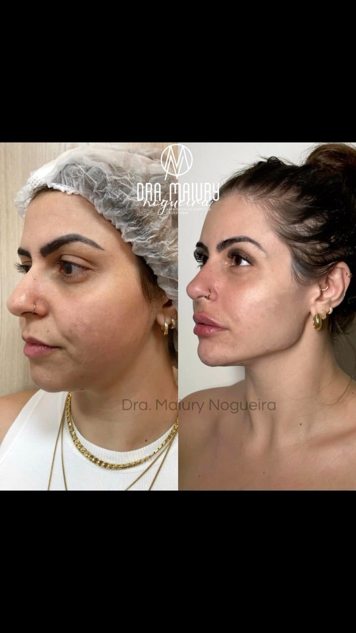 Post 10 by Dra. Maiury Nogueira | HARMONIZAÇÃO FACIAL on Instagram (video)