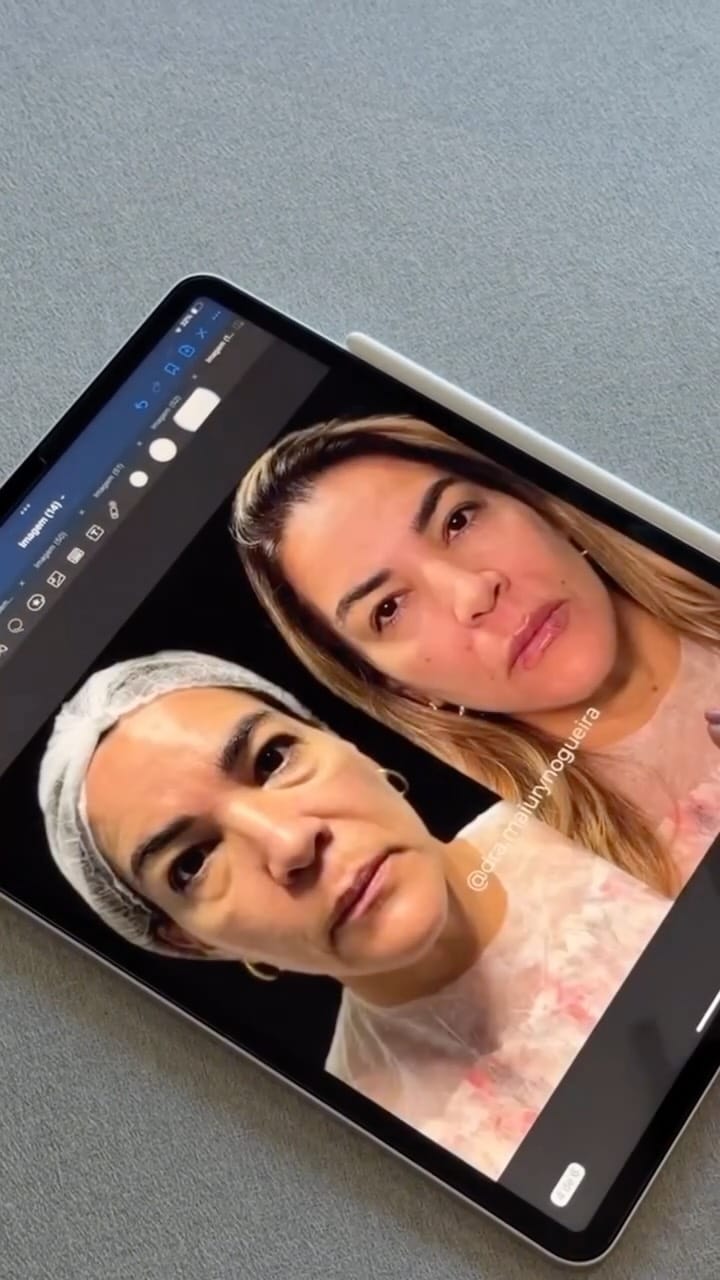 Post 2 by Dra. Maiury Nogueira | HARMONIZAÇÃO FACIAL on Instagram (video)
