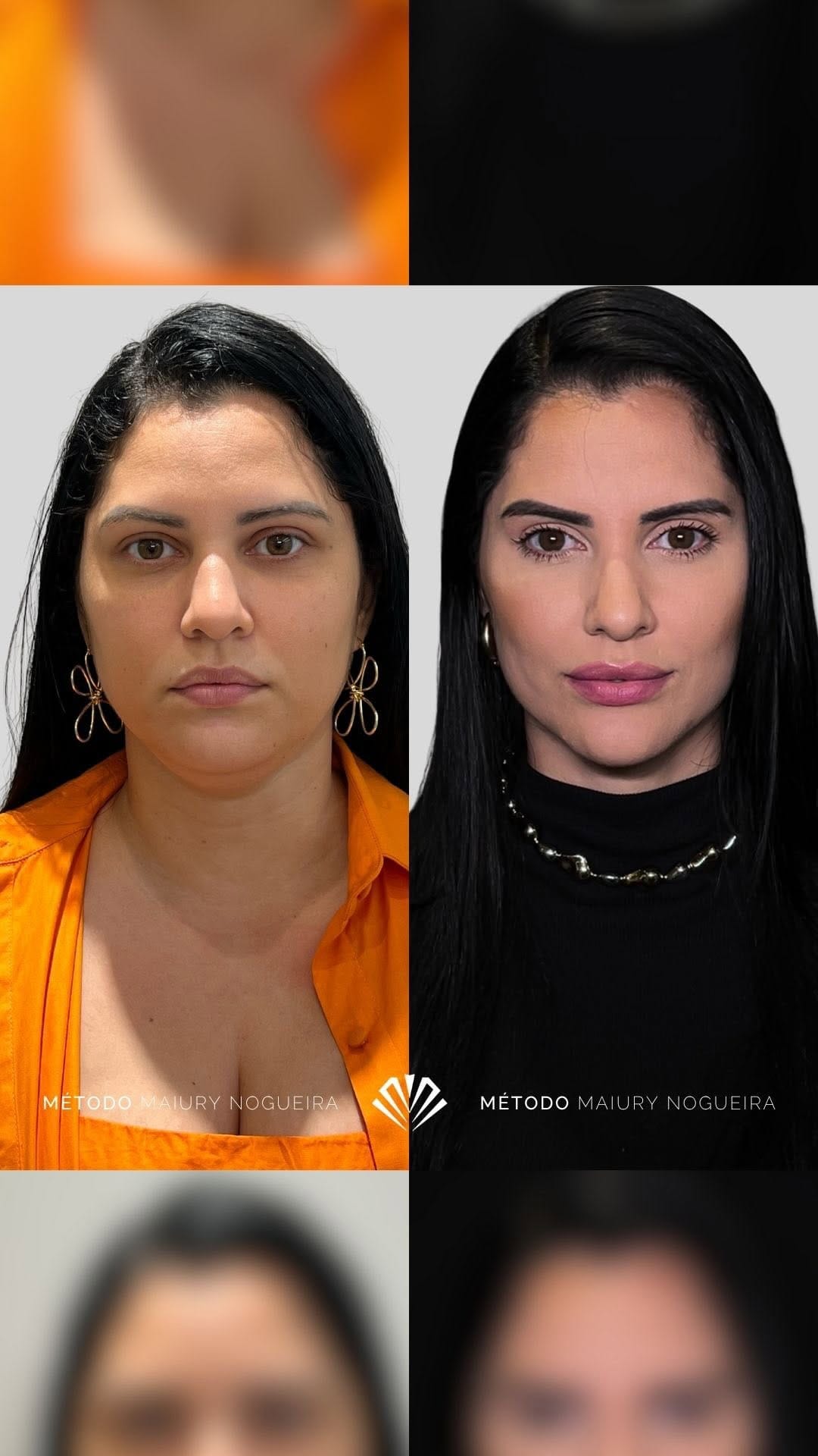 Post 9 by Dra. Maiury Nogueira | HARMONIZAÇÃO FACIAL on Instagram (video)