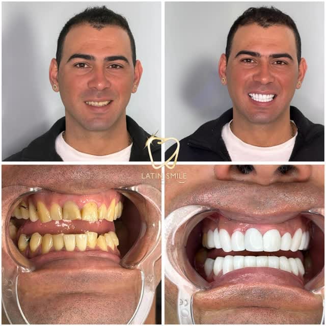 Post 5 by Latin Smile Dental Clinic on Instagram (video)
