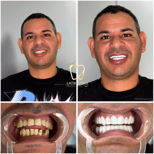 Post 7 by Latin Smile Dental Clinic on Instagram (video)