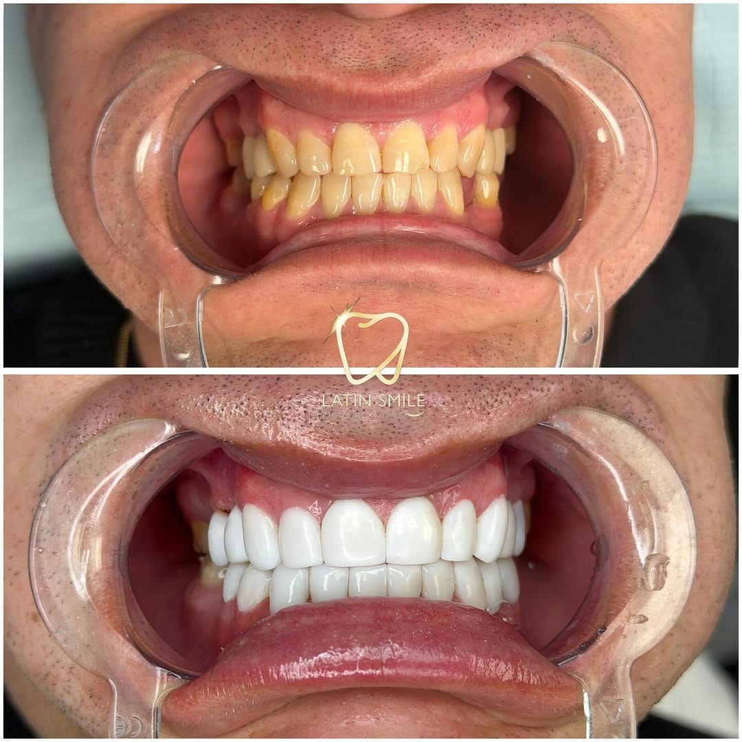 Post 4 by Latin Smile Dental Clinic on Instagram (image)