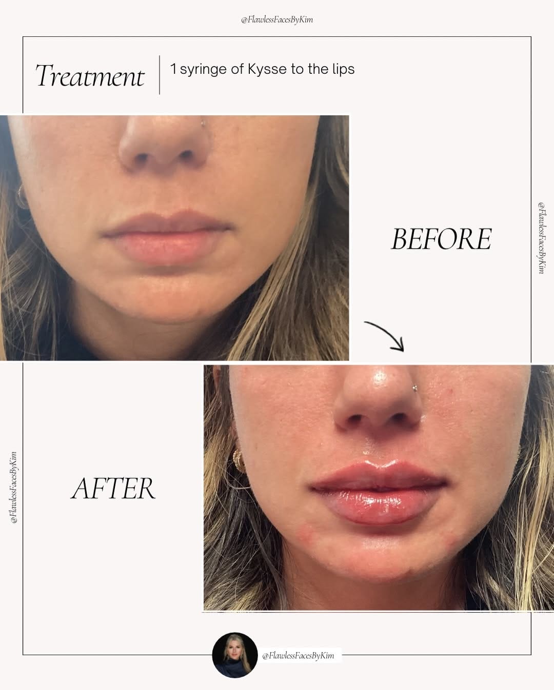 Post 3 by Kimberly Clemente | Aesthetic Injector | Nurse Practitioner on Instagram (carousel)