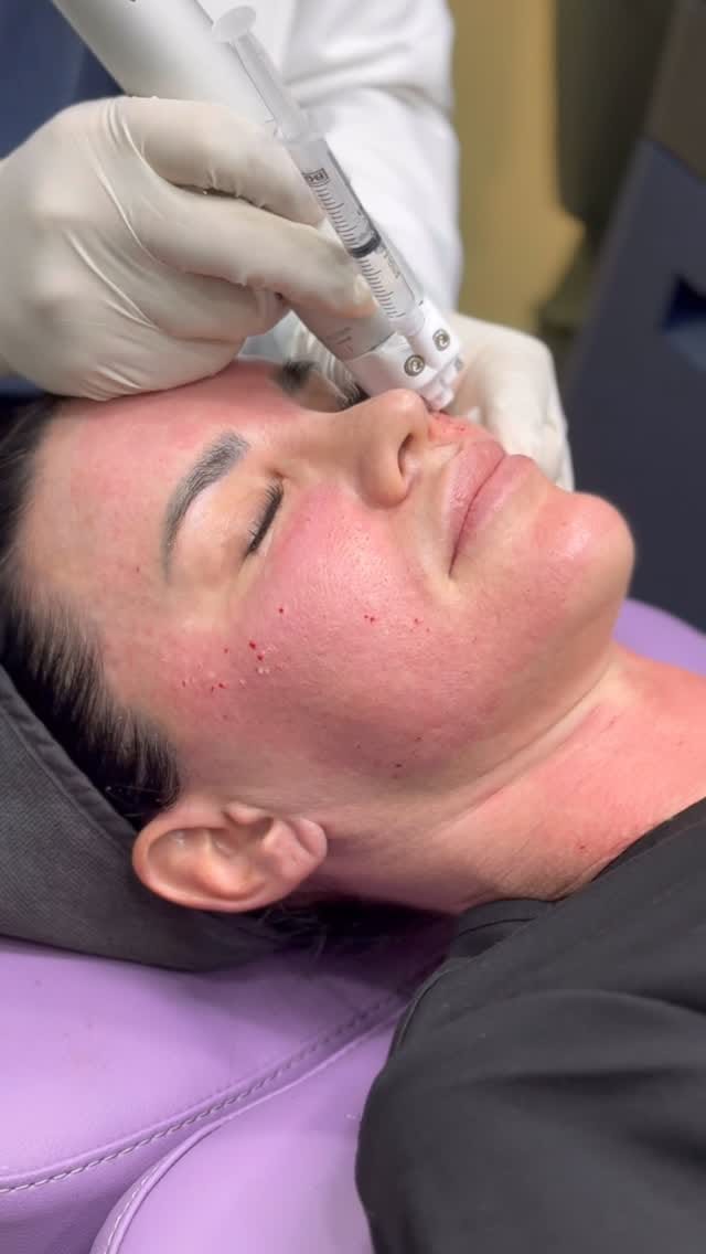 Post 3 by Liz deChadenedes| ADVANCED AESTHETIC INJECTOR on Instagram (video)