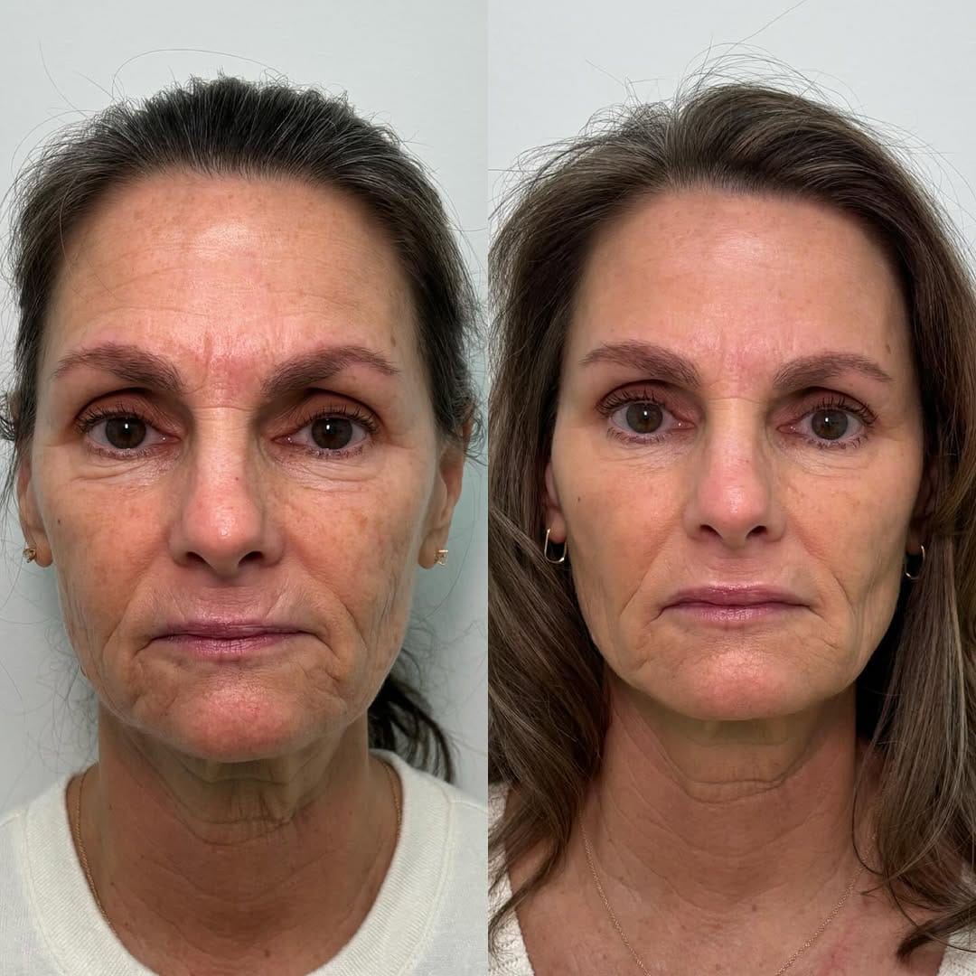 Post 10 by Liz deChadenedes| ADVANCED AESTHETIC INJECTOR on Instagram (carousel)