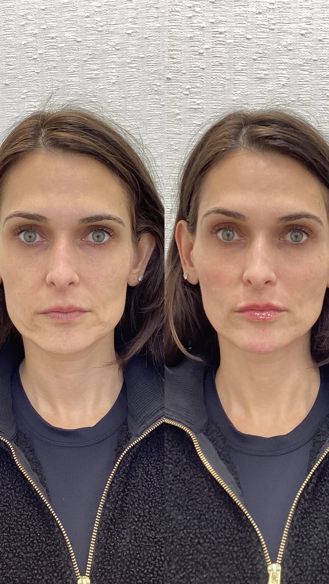 Post 4 by Liz deChadenedes| ADVANCED AESTHETIC INJECTOR on Instagram (video)