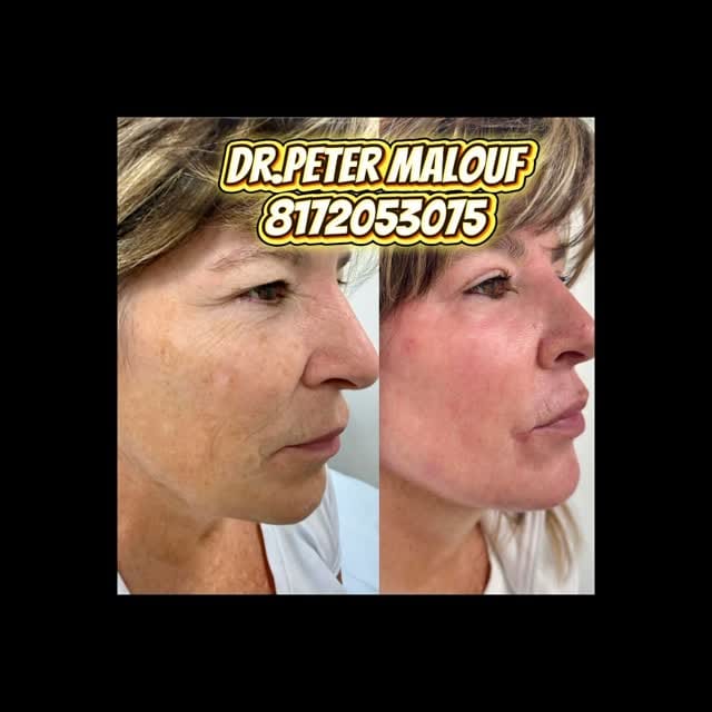 Post 3 by Dr.Peter Malouf on Instagram (video)