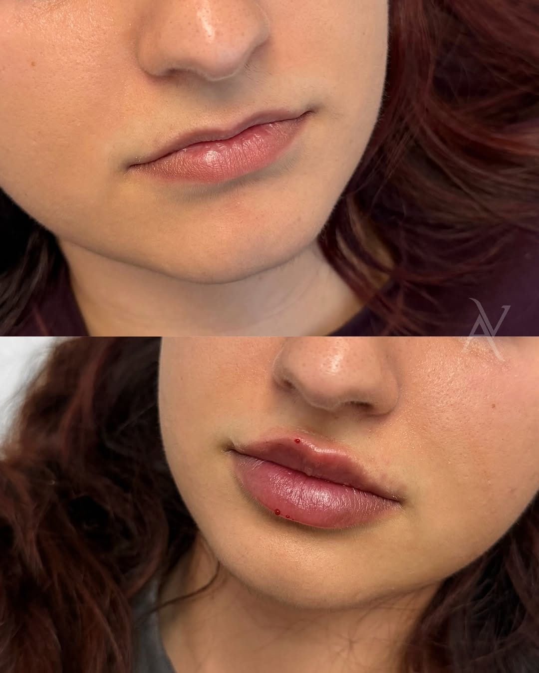 Post 5 by Ani Vardanyan | RN,  AESTHETIC INJECTOR on Instagram (image)
