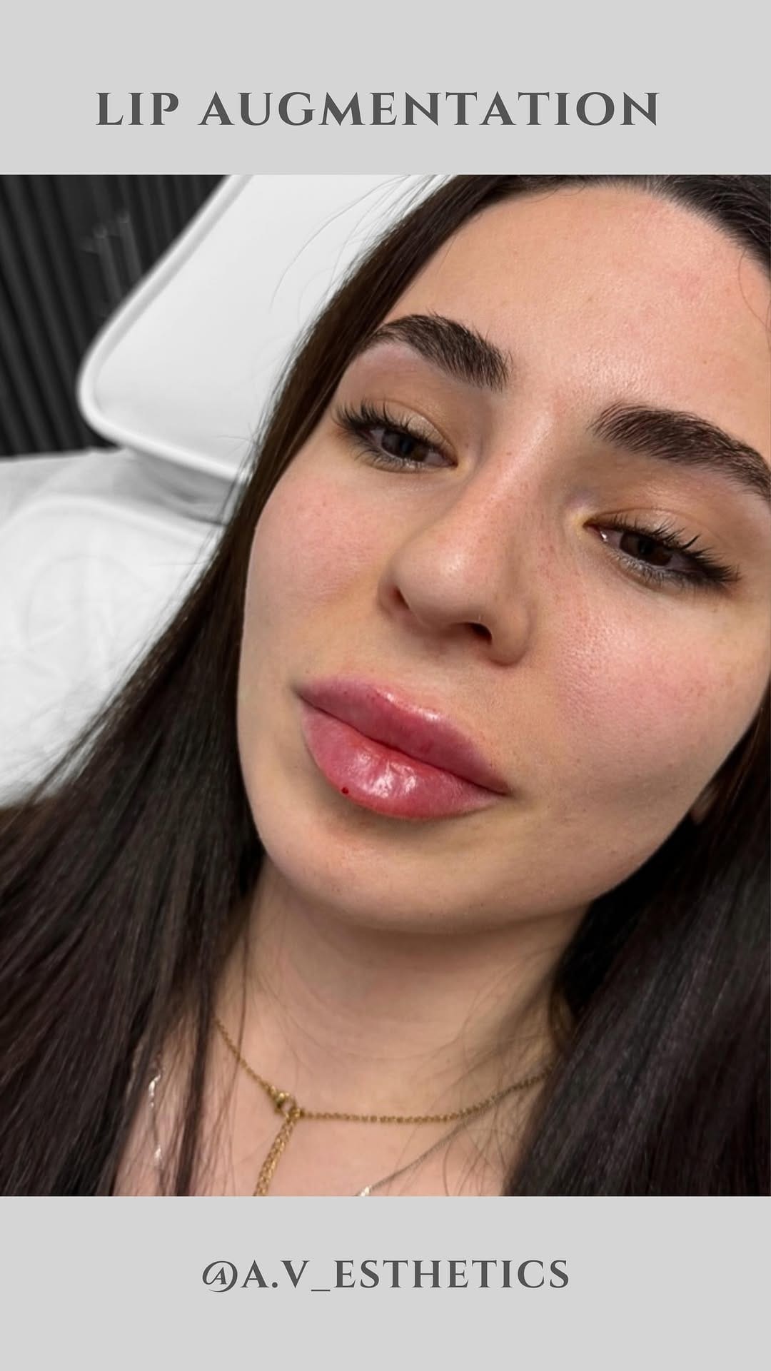 Post 4 by Ani Vardanyan | RN,  AESTHETIC INJECTOR on Instagram (video)