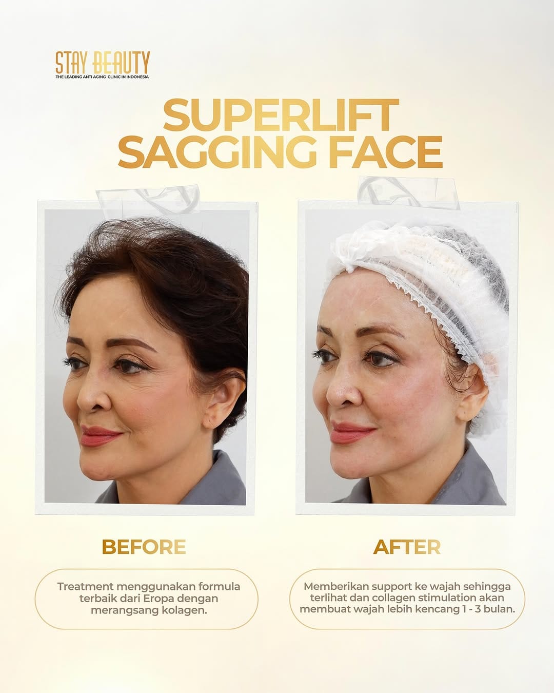 Post 9 by Stay Beauty - The Leading Antiaging Clinic in Indonesia on Instagram (image)