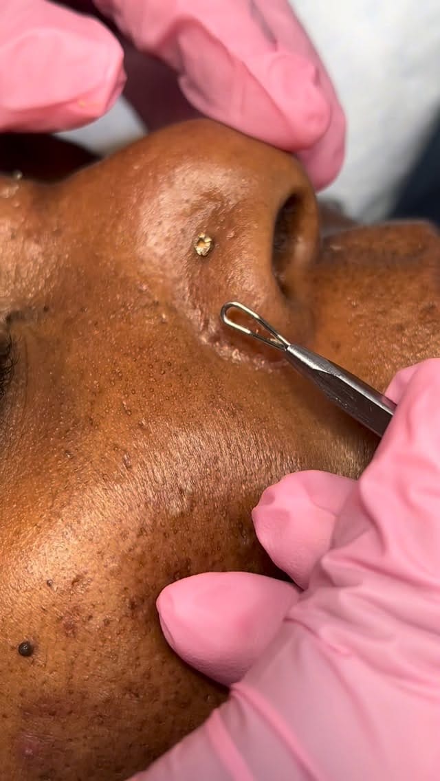 Post 2 by ATLANTA MEDICAL AESTHETICIAN | Jamesa on Instagram (video)