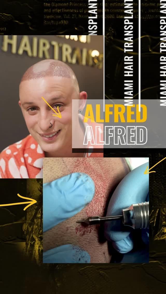 Post 4 by Miami Hair Transplant on Instagram (video)