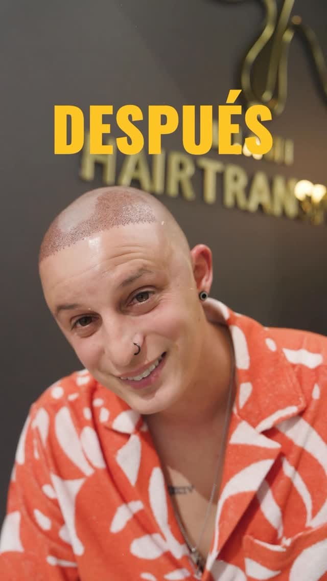 Post 7 by Miami Hair Transplant on Instagram (video)